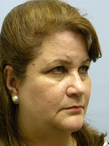 Facelift Before and After Pictures Miami, FL