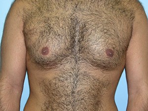 Gynecomastia Before and After Pictures Miami, FL