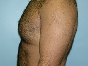 Gynecomastia Before and After Pictures Miami, FL