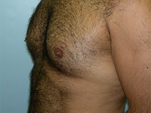 Gynecomastia Before and After Pictures Miami, FL