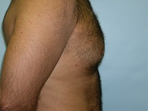 Gynecomastia Before and After Pictures Miami, FL