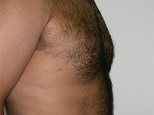 Gynecomastia Before and After Pictures Miami, FL