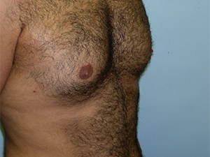 Gynecomastia Before and After Pictures Miami, FL