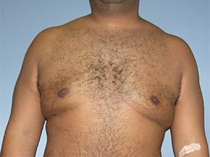 Gynecomastia Before and After Pictures Miami, FL