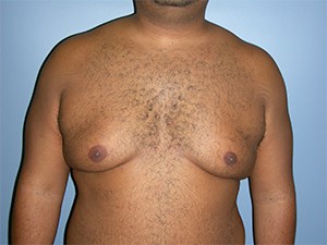 Gynecomastia Before and After Pictures Miami, FL