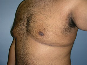 Gynecomastia Before and After Pictures Miami, FL