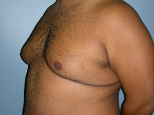 Gynecomastia Before and After Pictures Miami, FL