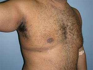 Gynecomastia Before and After Pictures Miami, FL