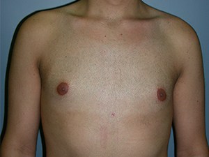 Gynecomastia Before and After Pictures Miami, FL