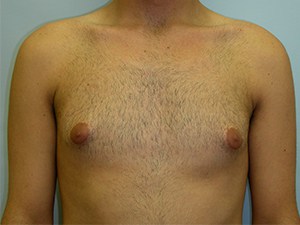 Gynecomastia Before and After Pictures Miami, FL