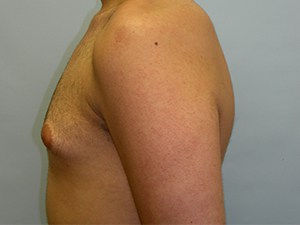 Gynecomastia Before and After Pictures Miami, FL