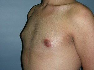 Gynecomastia Before and After Pictures Miami, FL