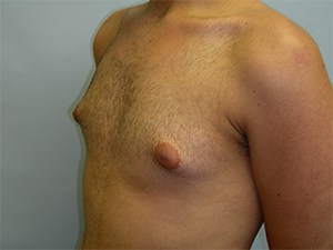 Gynecomastia Before and After Pictures Miami, FL