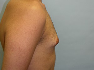 Gynecomastia Before and After Pictures Miami, FL