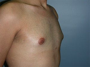 Gynecomastia Before and After Pictures Miami, FL