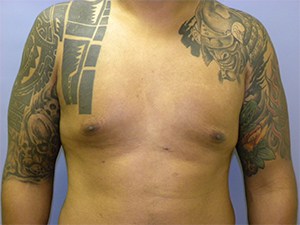 Gynecomastia Before and After Pictures Miami, FL