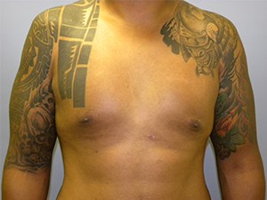 Gynecomastia Before and After Pictures Miami, FL