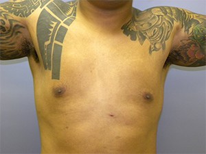 Gynecomastia Before and After Pictures Miami, FL