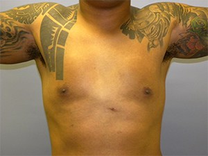 Gynecomastia Before and After Pictures Miami, FL