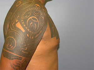 Gynecomastia Before and After Pictures Miami, FL