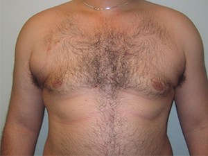 Gynecomastia Before and After Pictures Miami, FL