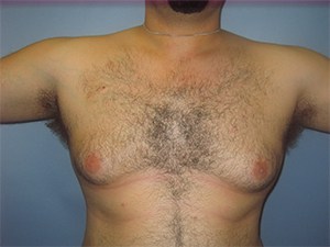 Gynecomastia Before and After Pictures Miami, FL