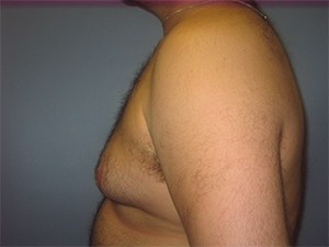 Gynecomastia Before and After Pictures Miami, FL