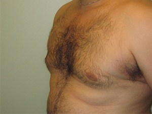 Gynecomastia Before and After Pictures Miami, FL