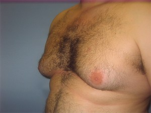 Gynecomastia Before and After Pictures Miami, FL