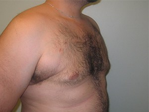 Gynecomastia Before and After Pictures Miami, FL