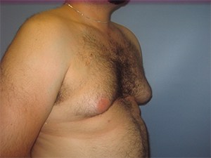 Gynecomastia Before and After Pictures Miami, FL