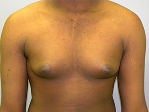 Gynecomastia Before and After Pictures Miami, FL