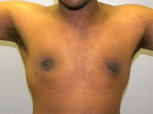 Gynecomastia Before and After Pictures Miami, FL