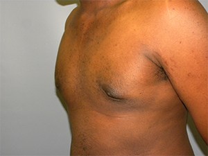 Gynecomastia Before and After Pictures Miami, FL