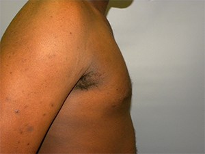 Gynecomastia Before and After Pictures Miami, FL