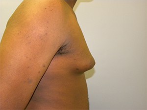 Gynecomastia Before and After Pictures Miami, FL