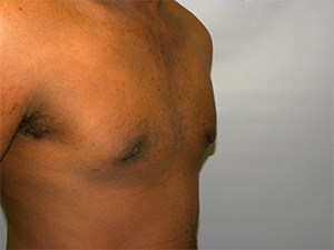 Gynecomastia Before and After Pictures Miami, FL