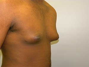 Gynecomastia Before and After Pictures Miami, FL