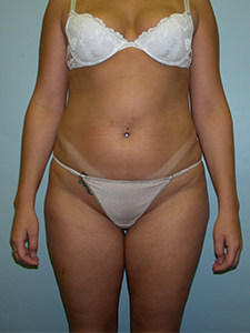 Liposuction Before and After Pictures Miami, FL