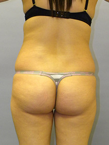 Liposuction Before and After Pictures Miami, FL