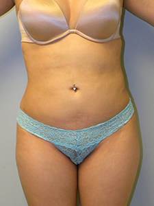 Liposuction Before and After Pictures Miami, FL