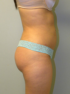 Liposuction Before and After Pictures Miami, FL