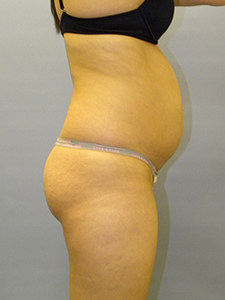 Liposuction Before and After Pictures Miami, FL