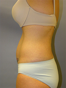 Liposuction Before and After Pictures Miami, FL