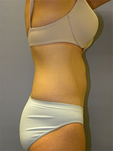 Liposuction Before and After Pictures Miami, FL
