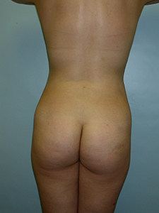 Liposuction Before and After Pictures Miami, FL