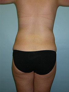 Liposuction Before and After Pictures Miami, FL