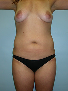 Liposuction Before and After Pictures Miami, FL