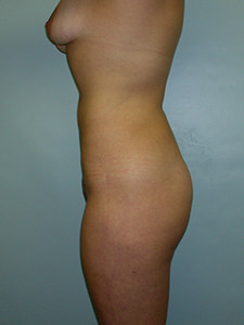 Liposuction Before and After Pictures Miami, FL