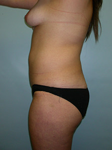 Liposuction Before and After Pictures Miami, FL